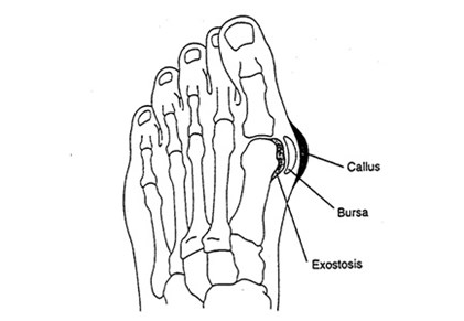 Bunions and Hammer Toes